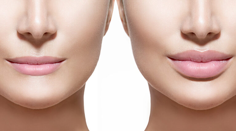 Before and after lip filler injections. Lips closeup over white Before and after lip filler injections. Lips closeup over white