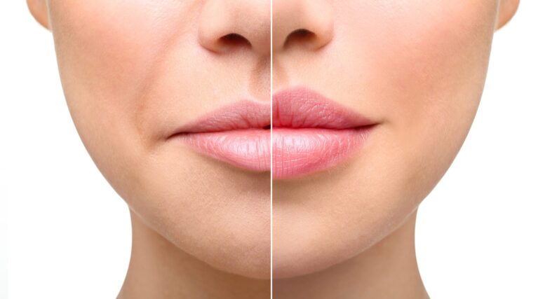Smile-Lines-scaled Smile-Lines-scaled